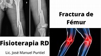 Rehabilitación de fractura del hueso fémur. Fisioterapia RD - YouTube