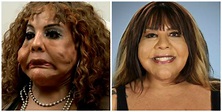 See the Most Extreme Plastic Surgery Transformations on Botched!