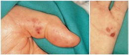 Image: Infective Endocarditis (Osler Node and Janeway Lesions) - MSD ...