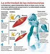 Esclerosis Lateral Amiotrófica - Clínica de Fisioterapia y Recuperación ...