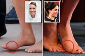 How Kate Middleton and Meghan Markle's feet have bunions and fallen ...