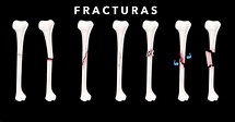 Fracturas - Ortopedista en Tijuana. Síntomas, Causas y Tratamiento