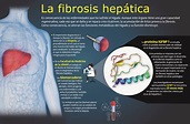 ¿Qué sabes sobre la Fibrosis hepática? | Descubre Fundación UNAM