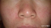 面部脂溢性皮炎如何修护与后期保养？ - 知乎