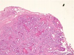 Adenocarcinoma of Cervix