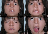 Moebius Syndrome Pasadena, CA | Best Facial Paralysis Treatment