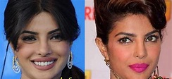 Priyanka Chopra Nose Job Before And After Picture - sekho.in