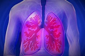 Enfermedad Pulmonar Obstructiva Crónica: qué es, por qué se produce y ...
