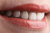 美白牙齒別亂貼！張箭球：「『陶瓷貼片』是牙齒美學最後一哩路」-風傳媒