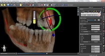 Guided Implants Treatment Planning Software Blue Sky Plan | Blue Sky ...