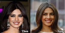 Priyanka Chopra Plastic Surgery Before and After Photos - Latest ...