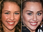 Miley Cyrus Before and After - The Skincare Edit