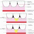 (PDF) Classification systems of gingival recession: An update