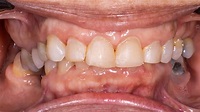 Como corrigir a Mordida Profunda - Ortodontia sem Segredos