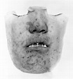 Photograph: facial scars of smallpox; | Wellcome Collection