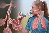 Using Asthma Inhaler to Open Airway Illustration by Todd Buck | Medical ...