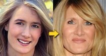 Chatter Busy: Laura Dern Plastic Surgery