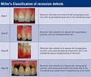 Gum Recession - Dentist Cambridge