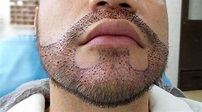 Trasplante capilar de barba - Clinica Capilar March