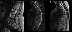 Figure 1 from Spinal Adhesive Arachnoiditis with Severe Neurological ...