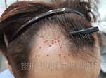 中國大陸植髮失敗後二次植髮修復案例