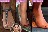 Meghan Markle ‘had toe-breaking surgery to perfect her feet’ after ...