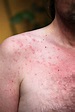 Rash or sun allergy stock photo. Image of allergies, pimples - 14962602