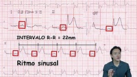 infarto do miocardio - parte2 - avaliando ECG - YouTube