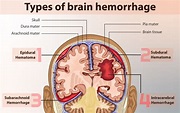 Difference between Intracranial Hemorrhage and Cerebral Hemorrhage ...