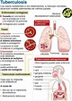 Cuidado con el contagio de la tuberculosis - Blog de farmacia