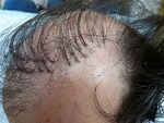 早期植髮失敗和現在植髮失敗的原因︱米蘭時尚診所