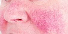 Broken Blood Vessels | Pure Dermatology | Metairie, LA