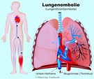 Lungenembolie, Symptome, Anzeichen, Lunge, Ursachen, Therapie, Vorbeugen