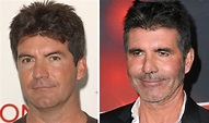 Simon Cowell’s drastically different face - Botox, ‘too much’ filler ...