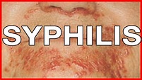 What Causes Syphilis? Symptoms and Signs, Treatment and Health Risks ...