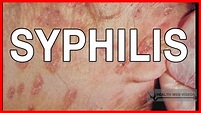 Syphilis: Symptoms, Stages of Syphilis, Causes and Treatment - YouTube