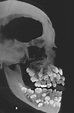 Freddie Mercury Teeth X Ray - Image to u