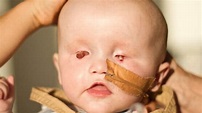 Baby born without eyes: GoFundMe campaign is trending for Archie | news ...