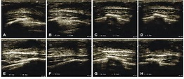 a–d Breast ultrasound scan showing bilateral gynecomastia in patient 1 ...
