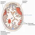 Hemorragia Cerebral – Cirugía Neurológica Integral de Oriente