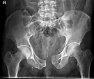 Open Book Fracture - wikiRadiography