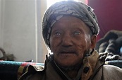 Bacteria That Cause Leprosy Are Undergoing Scary Mutations That Resist ...