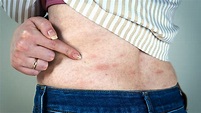 Acute and Chronic Hives and Rashes: Causes and Treatments - Ask The Doctor