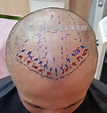 植髮失敗巨量植髮重修案例分析：錯誤髮流方向以及密度不足