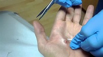 Getting stitches removed - YouTube