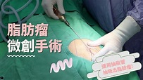 脂肪瘤微創手術、台中脂肪瘤切除手術-文心極緻美型診所-林子鈞醫師：台中粉瘤_粉瘤手術_微創粉瘤_粉瘤健保 - YouTube