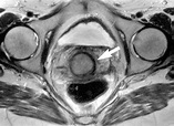 MR Imaging of Cervical Carcinoma: A Practical Staging Approach ...