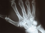 File:Metacarpal fractures.jpg - Wikipedia