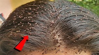 Beautiful long hair full of big lice - Big lice removal - YouTube