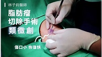 脂肪瘤切除手術 l 台中脂肪瘤 l 林子鈞醫師 - YouTube